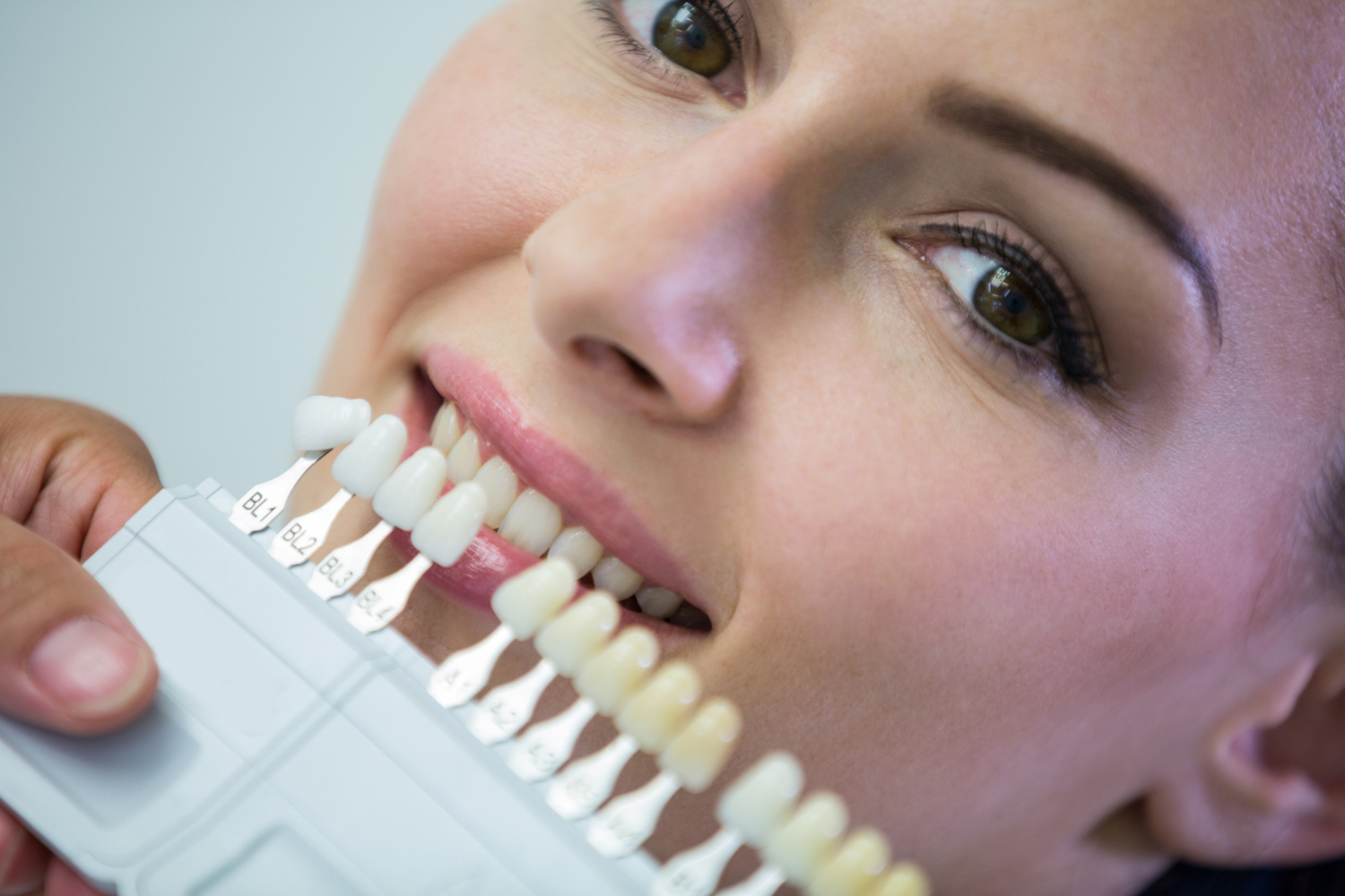 Teeth Veneers