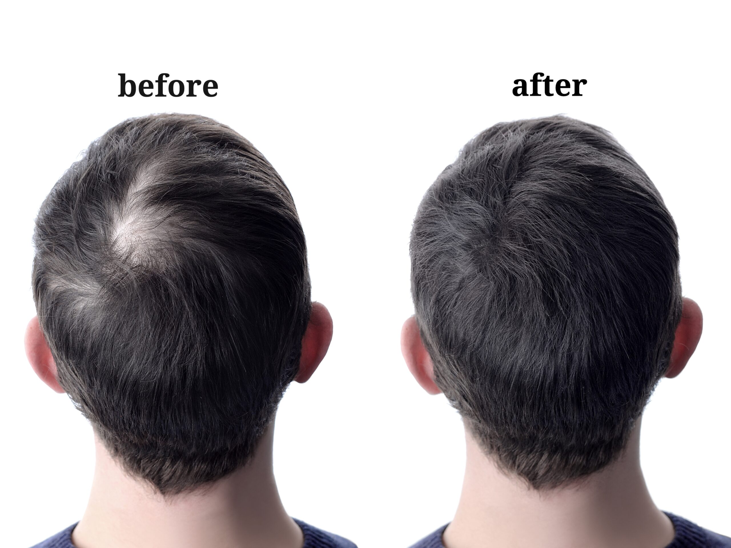 Hair Loss Treatment Before and After