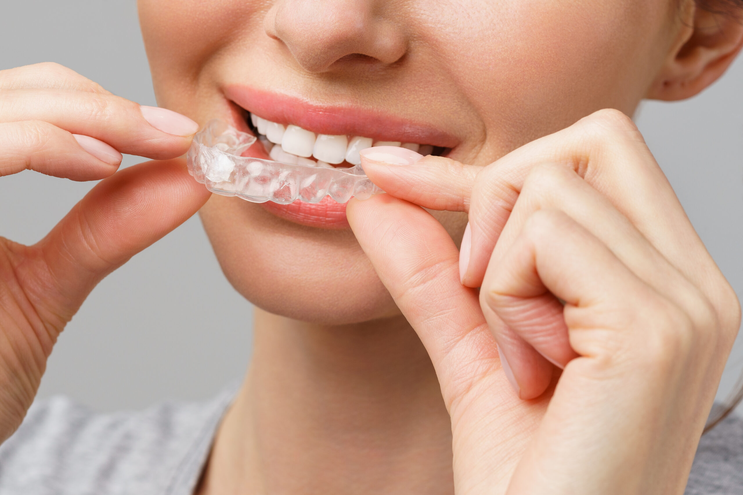 Teeth whitening
