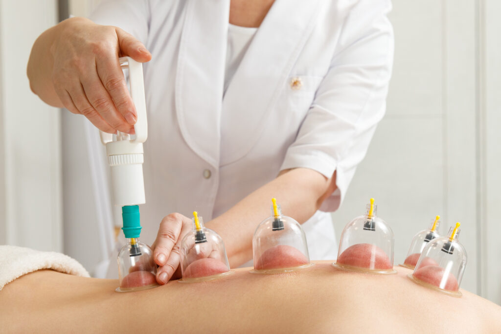 Vacuum massage. Vacuum cups of medical cupping therapy on woman back, close up, chinese medicine.